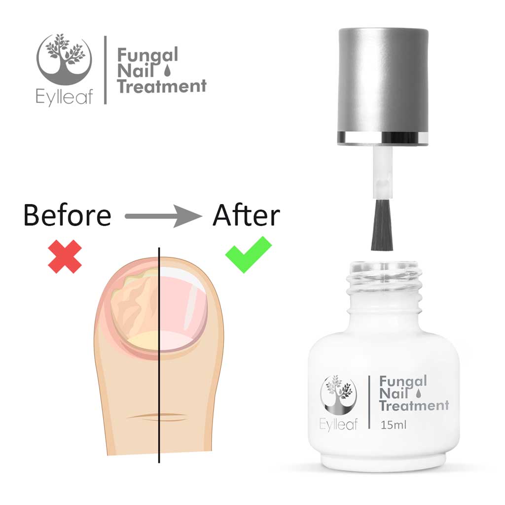 Fungal Treatment_before after_1024